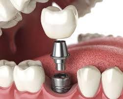 Implant Dentistry in Noida Through Floss Dental Clinic